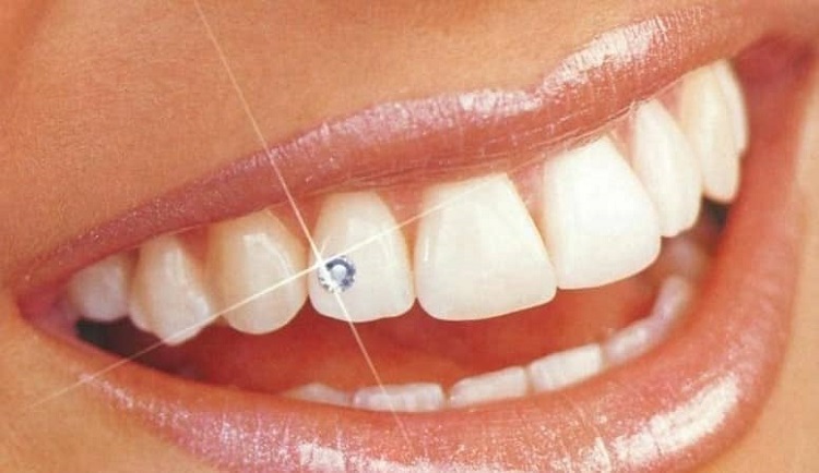 Скайсы на зубы Томск Флотский стоматология под наркозом томск